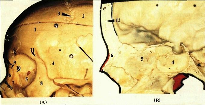 Connected By Frontal Suture