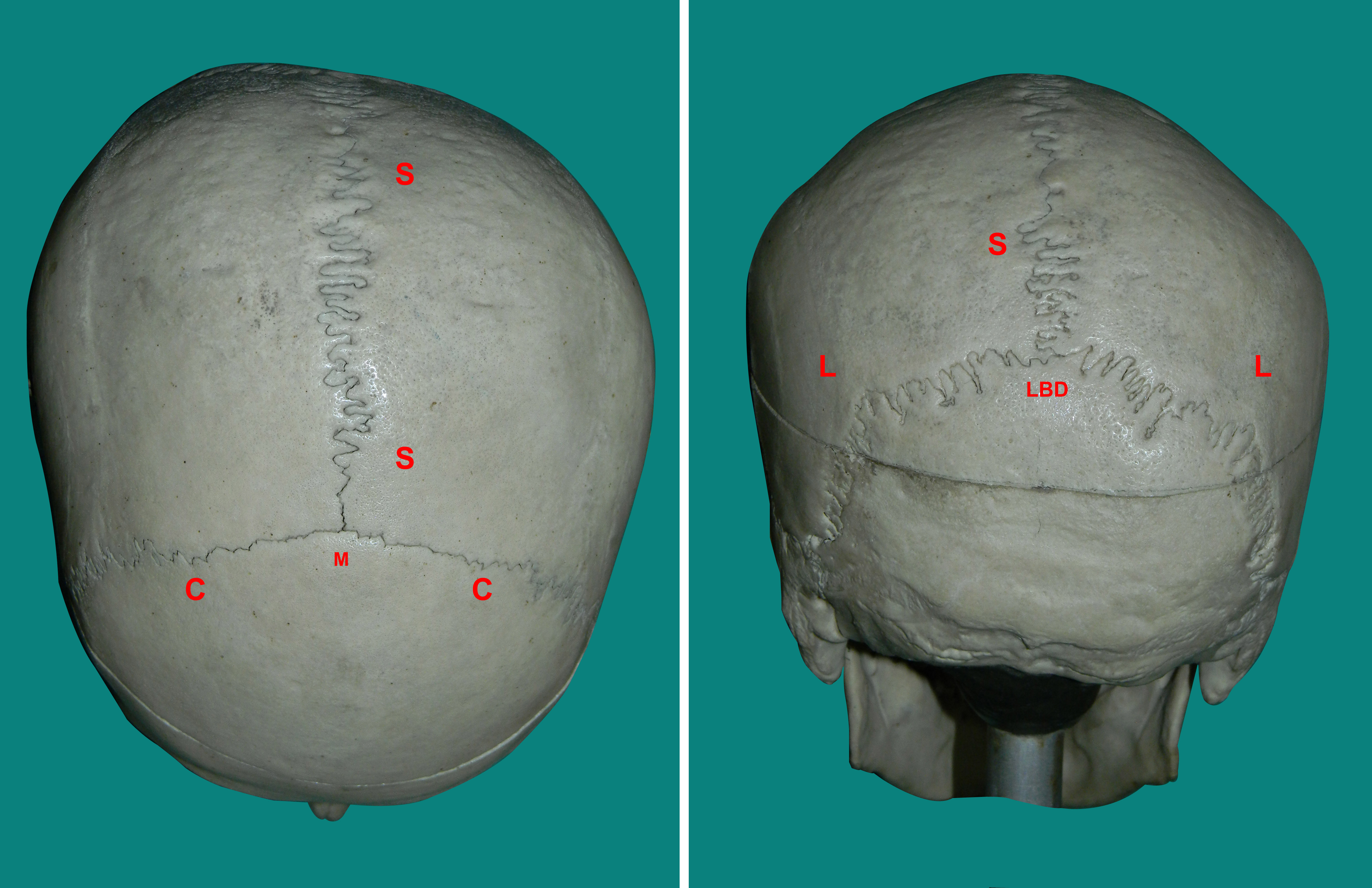 Frontal Suture