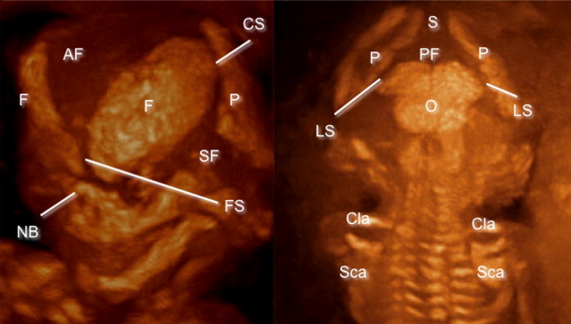 Frontal Suture