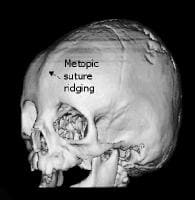 Frontal Suture Ridge