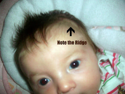 Frontal Suture Ridge