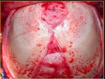 Prominent Frontal Suture