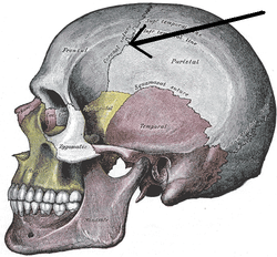 Prominent Frontal Suture