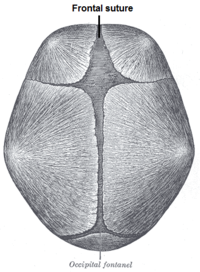 Prominent Frontal Suture